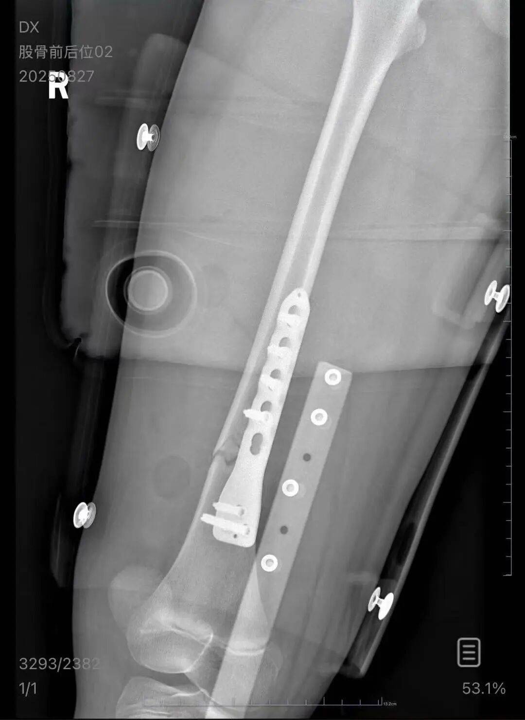 男子火车上铺跌落砸断10岁女孩腿骨<strong></p>
<p>XRP行情</strong>，回应“失联”称失业讨薪中