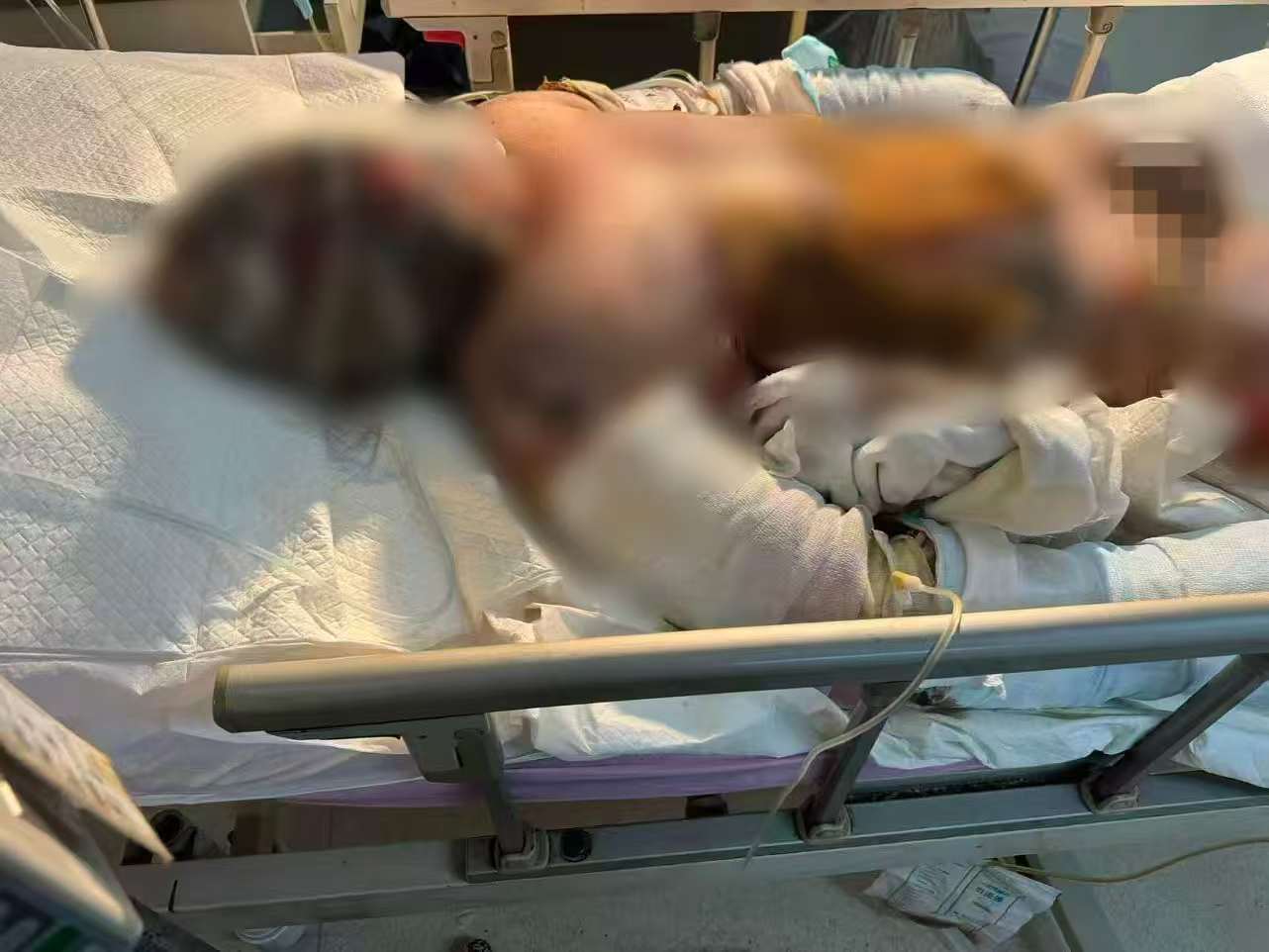 父子在哈尔滨一亲戚公司上班遇爆炸全身烧伤<strong></p>
<p>BNB行情</strong>，治疗花费近百万公司拒赔偿？亲戚回应