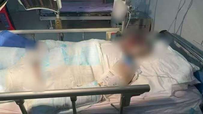 父子在哈尔滨一亲戚公司上班遇爆炸全身烧伤<strong></p>
<p>BNB行情</strong>，治疗花费近百万公司拒赔偿？亲戚回应