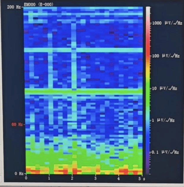 山西首例<strong></p>
<p>BITOP价格</strong>！山西省人民医院成功实施脑机接口辅助功能区脑肿瘤切除手术