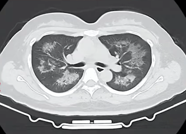 每天用2次<strong></p>
<p>虚拟货币矿机</strong>，22岁女主播肺里长满阴影！很多人不注意