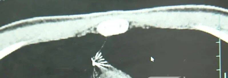 17岁小伙参军体检发现胸腔内有根5cm缝衣针<strong></p>
<p>虚拟货币ico</strong>,父母回忆或是1岁时扎入,取出时已锈迹斑斑