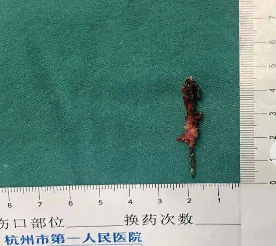 17岁小伙参军体检发现胸腔内有根5cm缝衣针<strong></p>
<p>虚拟货币ico</strong>,父母回忆或是1岁时扎入,取出时已锈迹斑斑